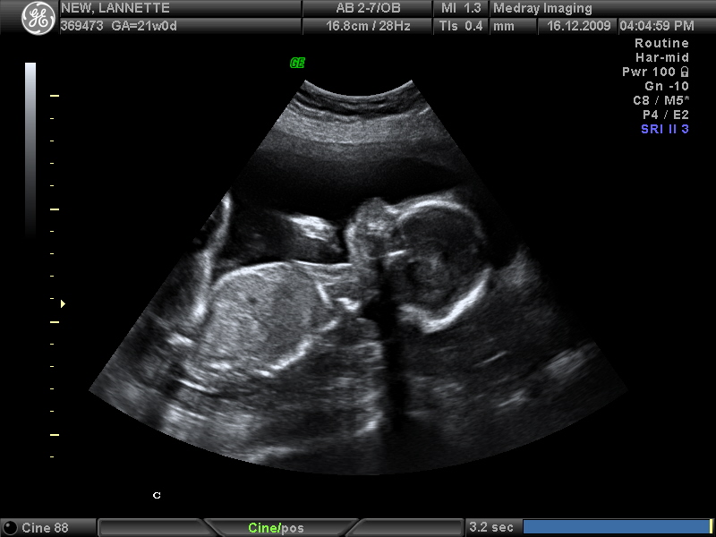 Baby New at 21 weeks (Dec 16.09)